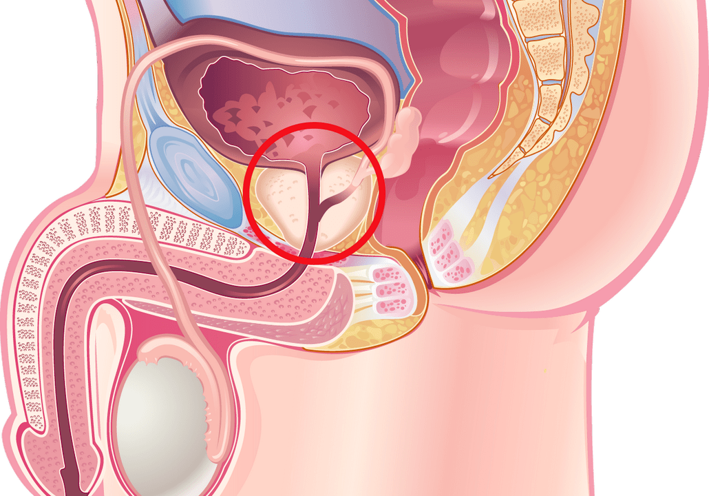 Symptômes et signes d'inflammation de la prostate