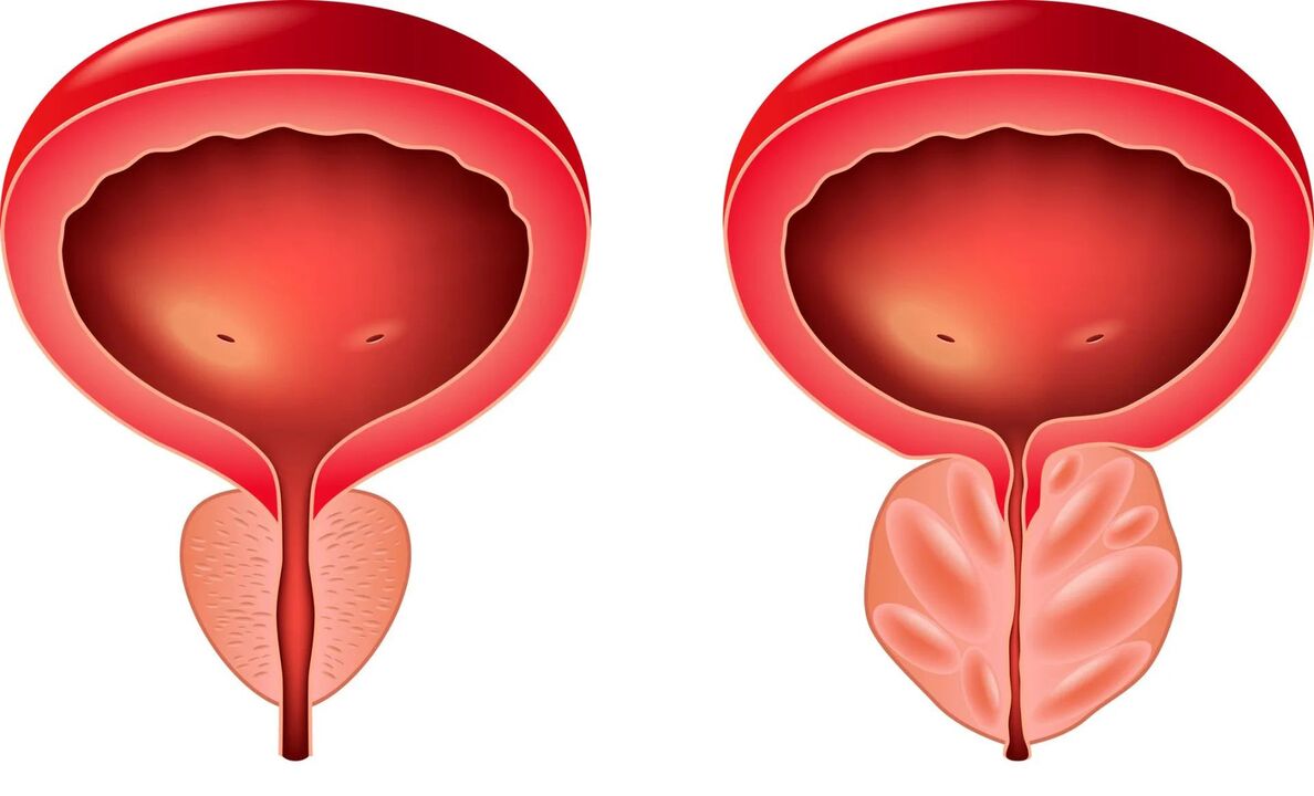 prostate normale et malade