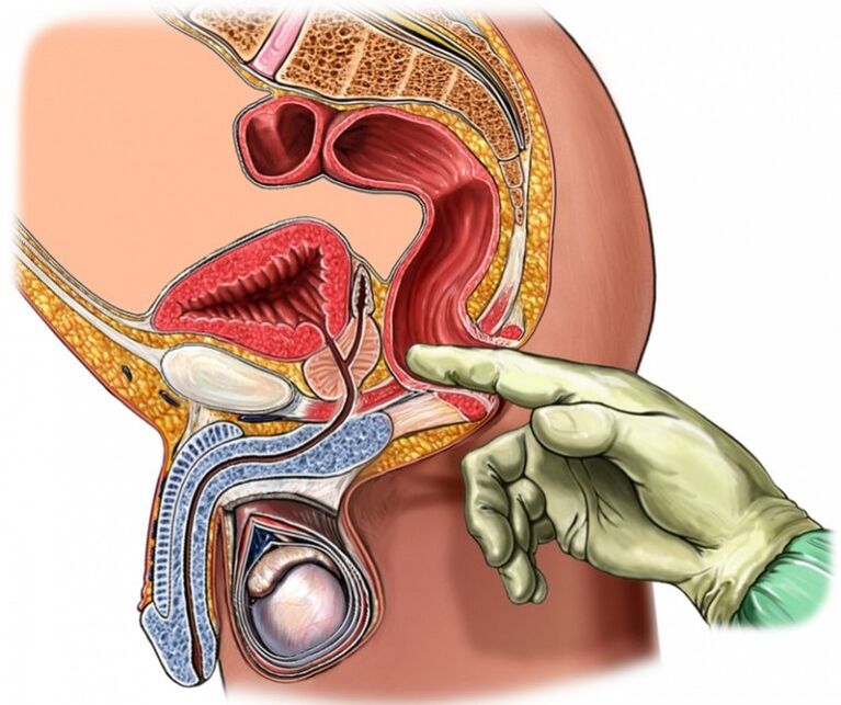 Massage de la prostate pour l'inflammation de la prostate