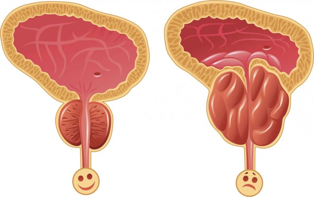 Symptômes de l'inflammation de la prostate chez les hommes